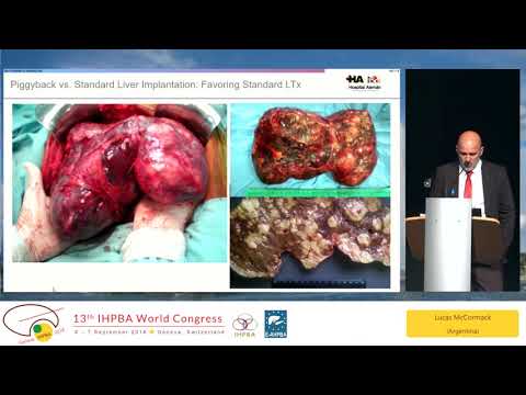 DEB07.2 Piggyback vs Standard Liver Implantation