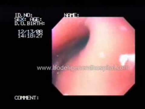 Nissan acid reflux surgery #2