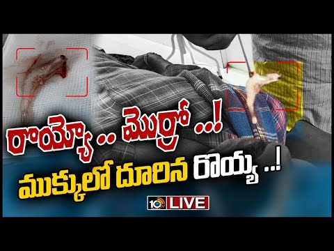 Doctor removes prawn out of man’s nose in Andhra Pradesh