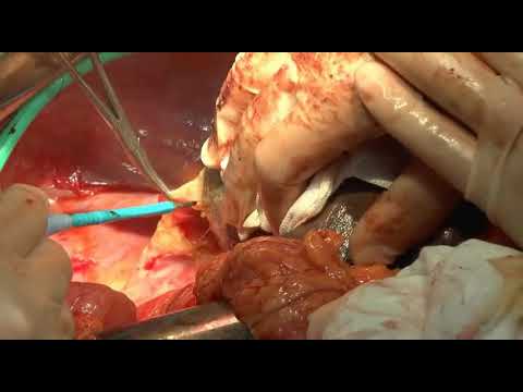 Surgical Treatment of a Case of Hilar Cholangiocarcinoma