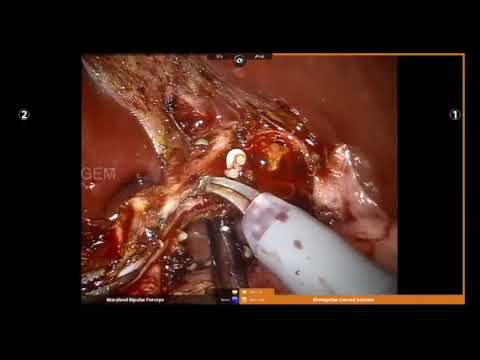 Robotic Choledochal Cyst Excision with Dual Hepaticojejunostomy for a 22 Month Old Child