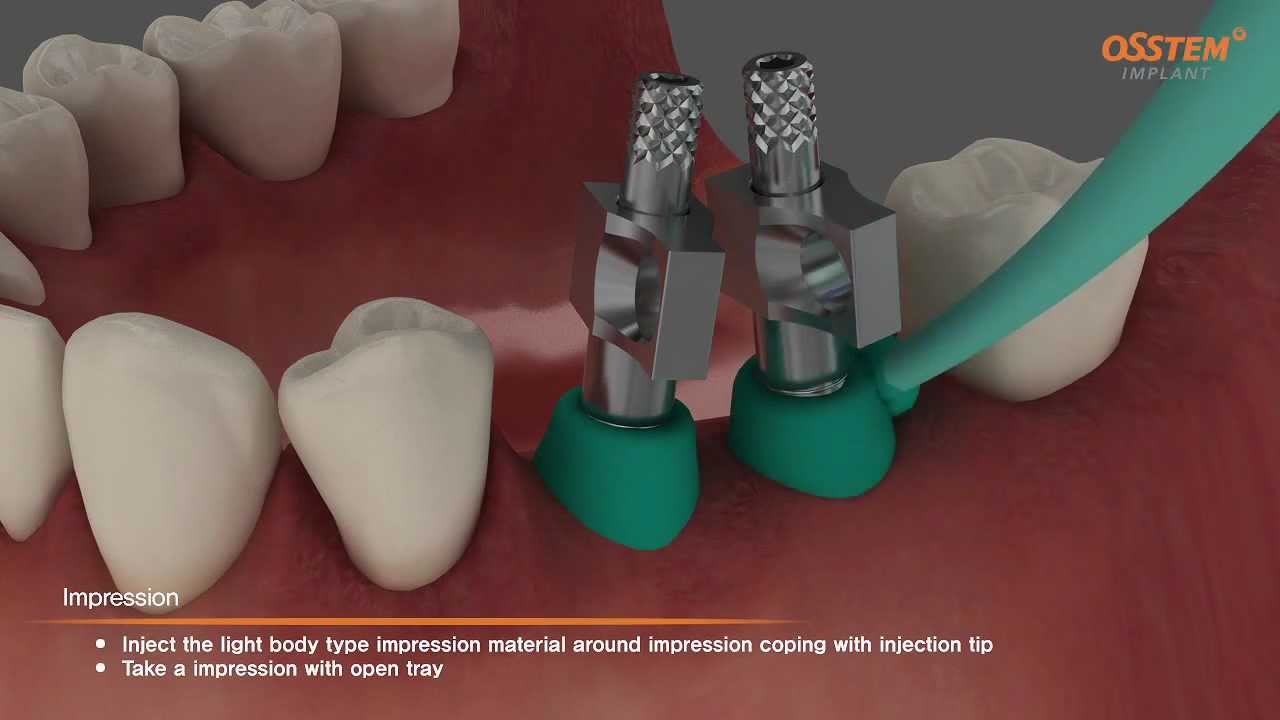 TSIII Fixture Placement & Impression Taking (Pick-up And Transfer ...