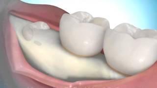 Removing Impacted Wisdom Teeth