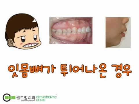 만화로 보는 킬본 A-point 돌출입교정