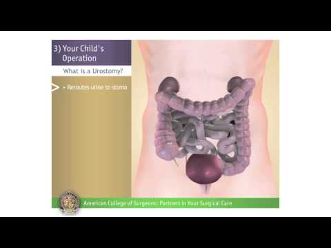 Pediatric Urostomy: Your Child's Operation