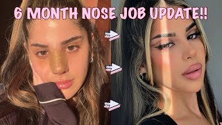 6 MONTH POST OP NOSE JOB UPDATE + Q&A *with discount code*