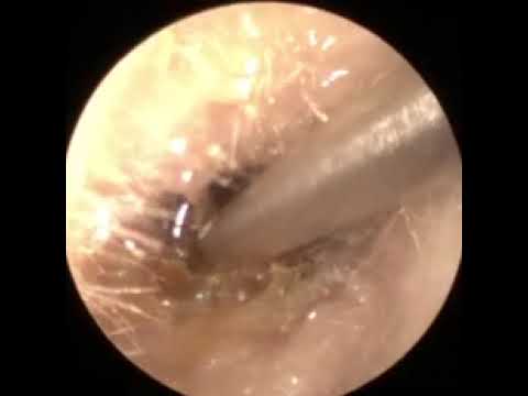 Ear wax removal London: Verified Hearing