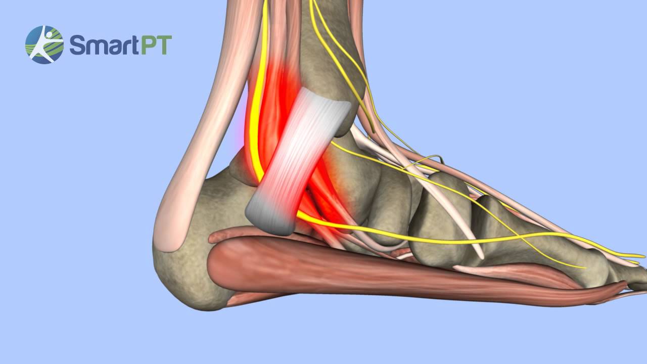 Tarsal Tunnel Syndrome - YouTube