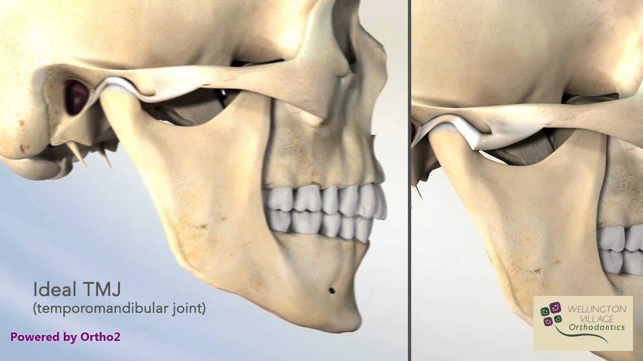 Closed Lock Tmj Lock Jaw Wellington Village Orthodontics Youtube