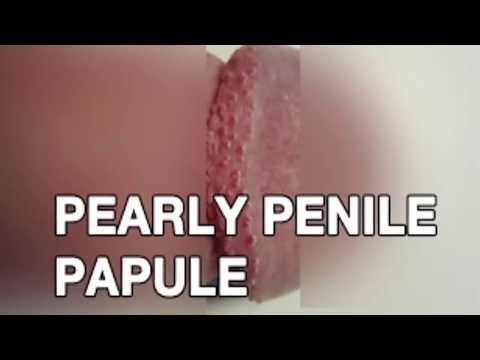 Pearly penile papules laser treatment