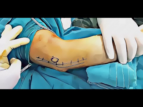 Cubital Tunnel Syndrome (Diagnosis and Treatment)