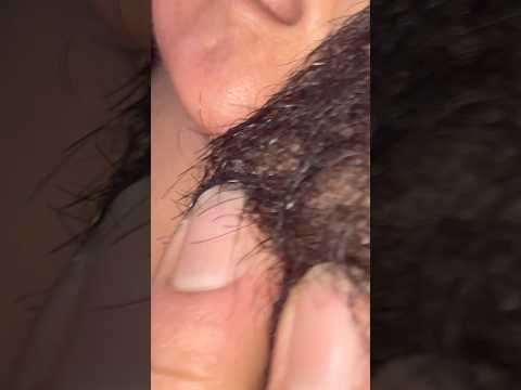 #asmrhair #blackheads #remove #reels #ingrownhair