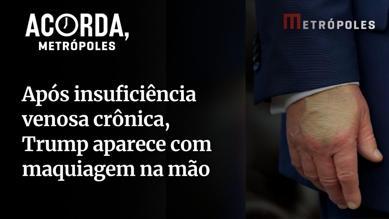 Confira: Trump aparece com novos hematomas na mão, após insuficiência venosa crônica