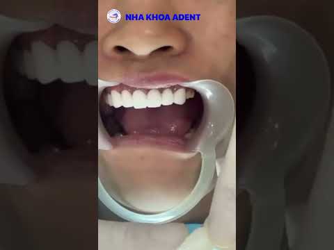 Khách hàng bọc sứ tại Nha Khoa ADENT