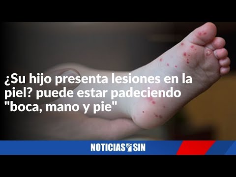 ¿Lesiones en piel del niño? puede ser "boca pie"