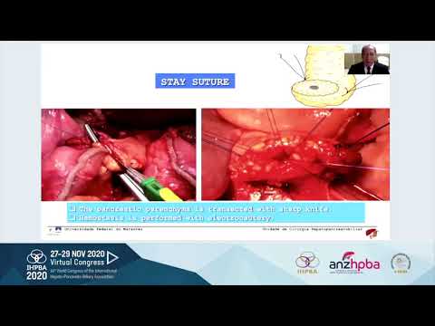 MTP18 - Pancreas Anastomosis and Management of POPF
