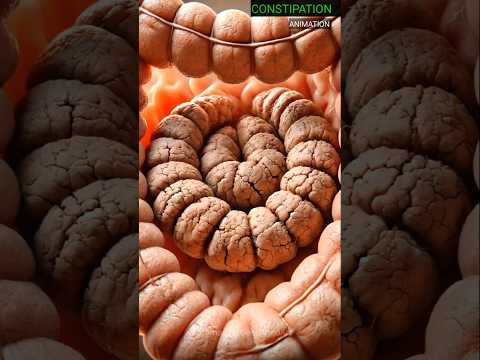 Constipation in Digestive System | Animation for Education |Stomach Ai Generated Art