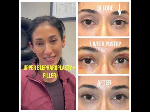 Woman underwent combined upper blepharoplasty and upper eyelid filler injection