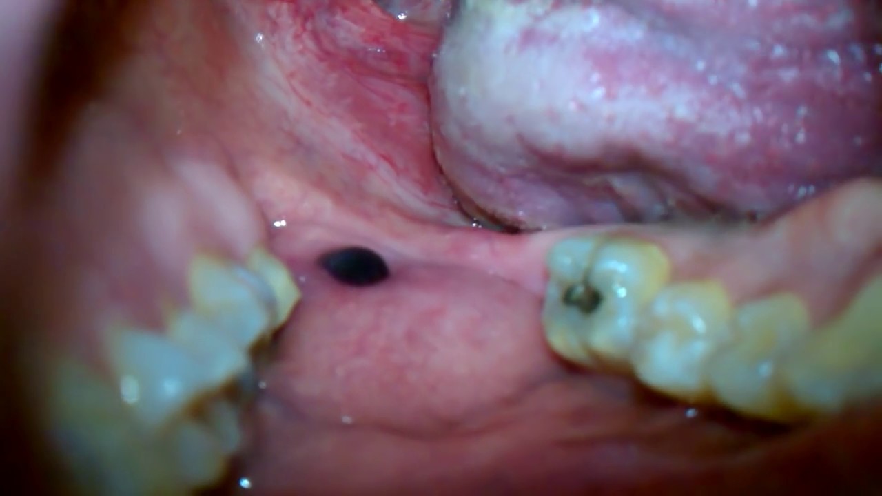 Black Lump In Mouth 106