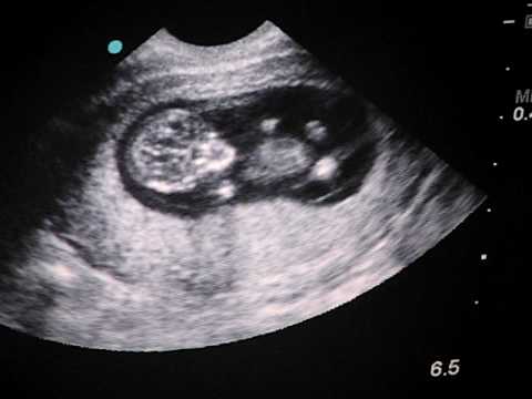 Baby's First Ultrasound 11 weeks 1 day - YouTube
