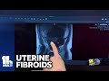 Womans Doctor: Whos at risk for uterine fibroids?