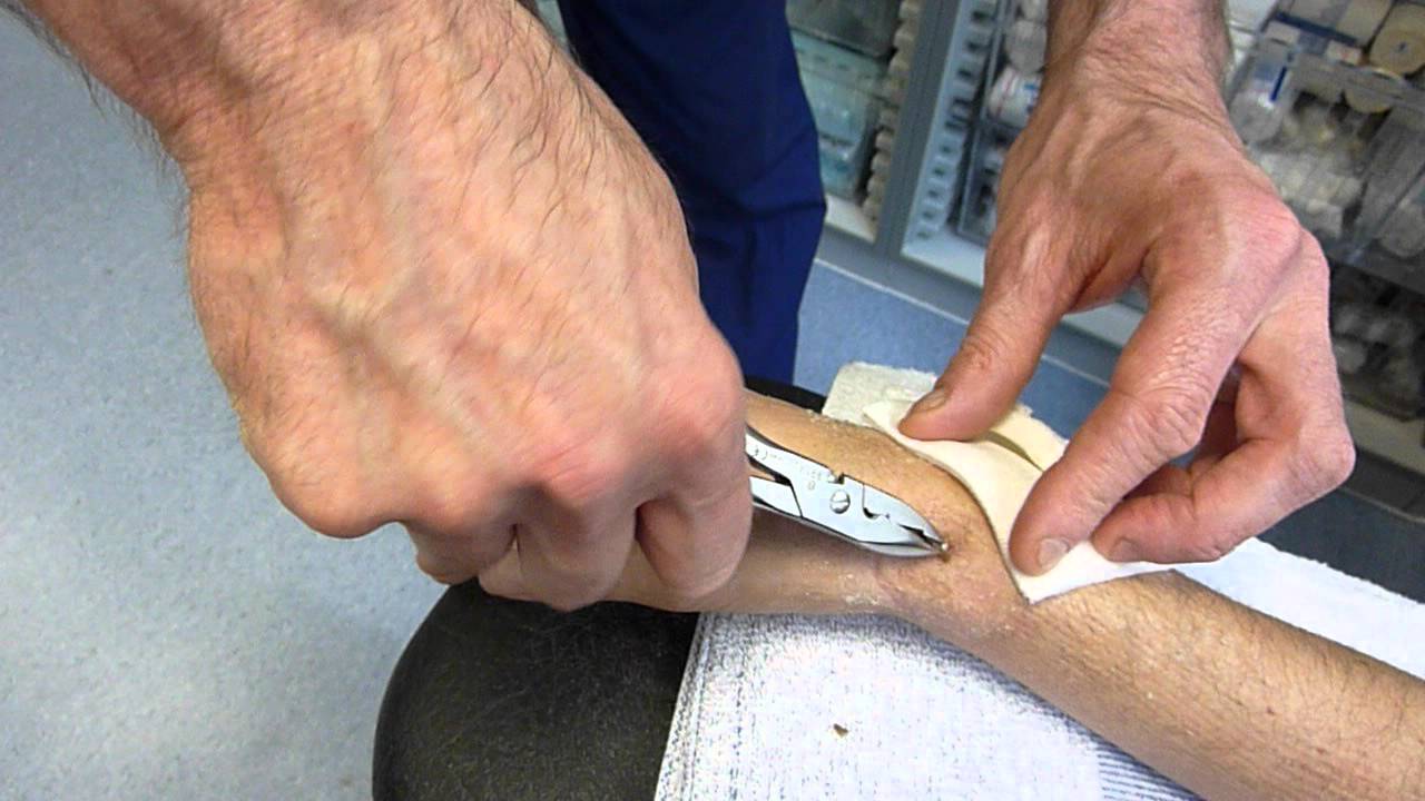 broken-wrist-k-wire-removal-youtube