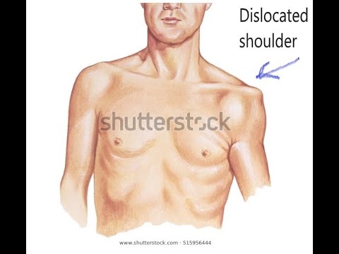 Shoulder Dislocations and Split Fractures of Humeral Head