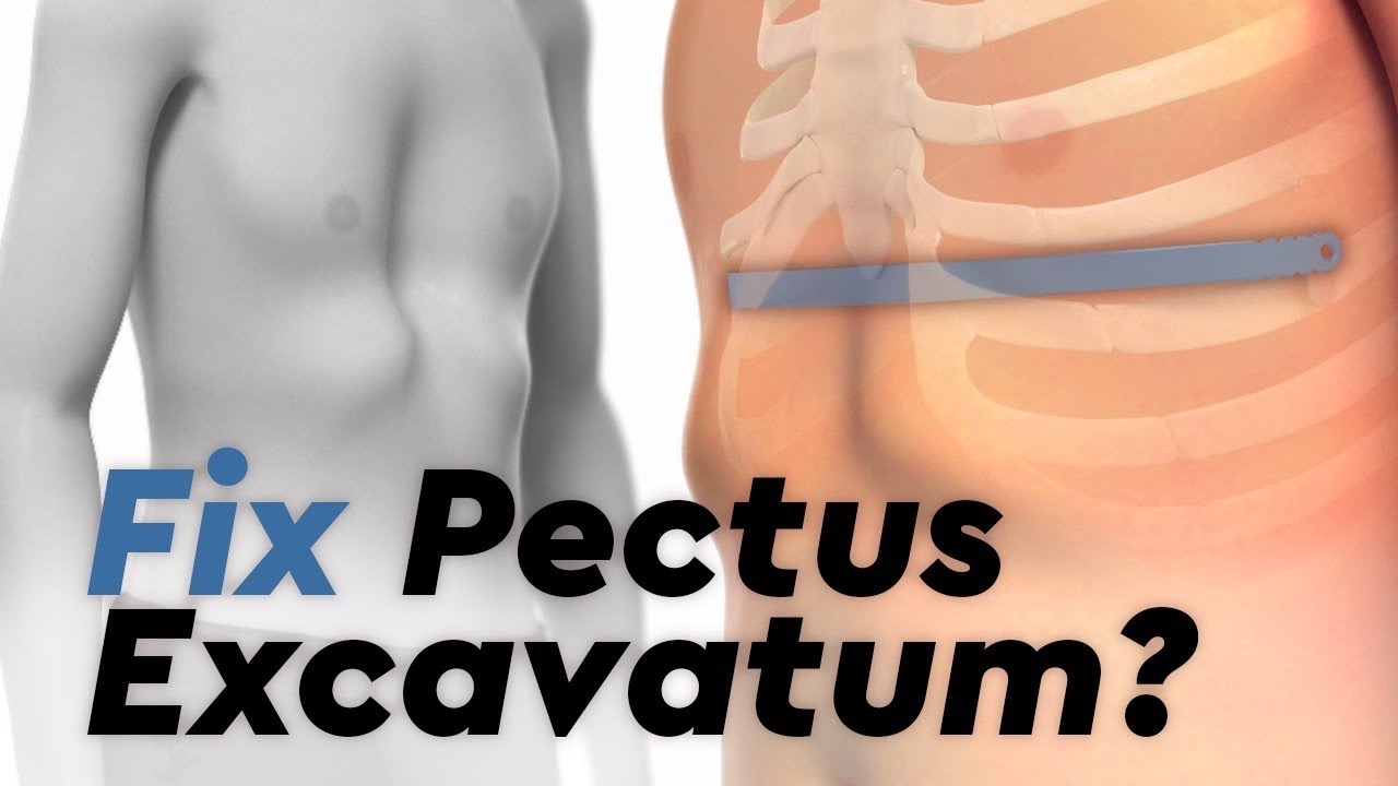 Treatment For Pectus Carinatum - Pectus Carinatum