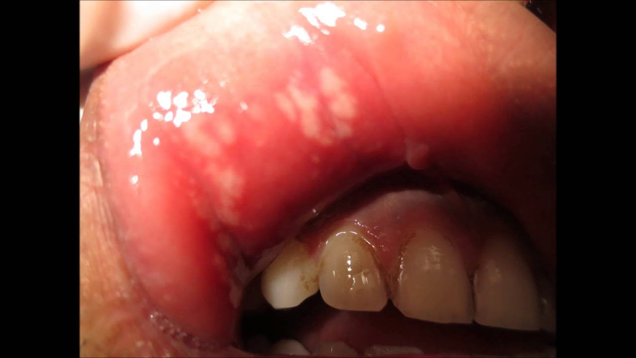 Blister on my upper lip that IS NOT A cold sore | Oral and ...