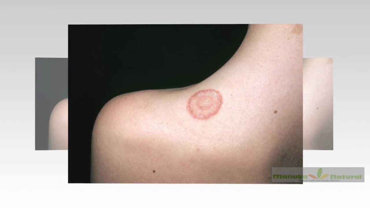 Natural Remedies For Ringworm In Humans YouTube Natural remedies for ringworm in humans youtube