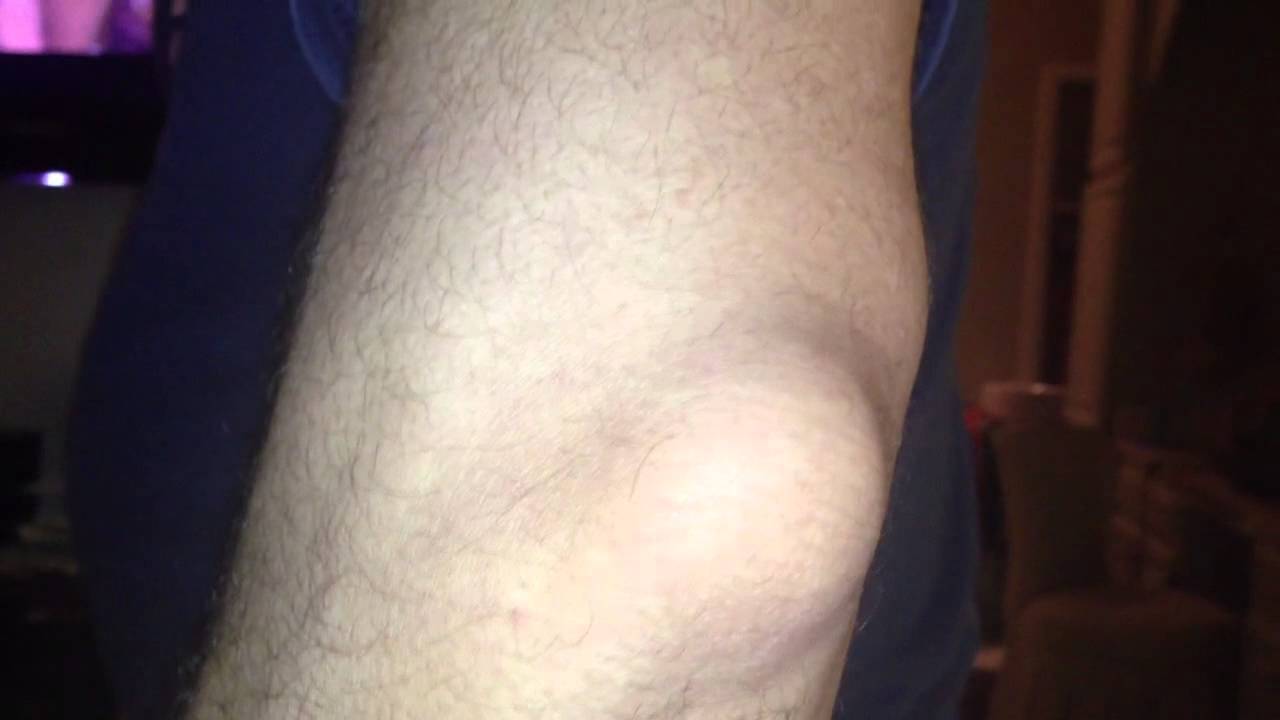 gout in elbow