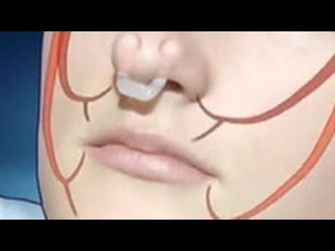 Как избавиться от храпа