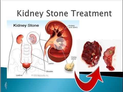 Kidney Stones Open Surgery