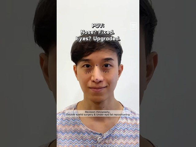 Revision rhinoplasty, double eyelid surgery & under eye fat repositioning💎 #plasticsurgery