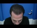 Hair Transplant Before After - Dr Hasson Patient 