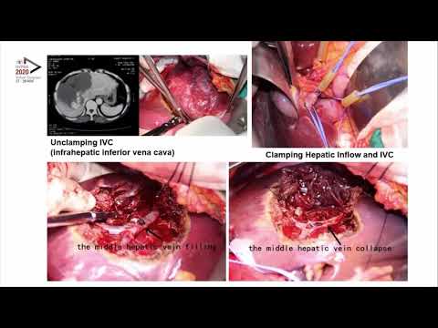 US01: Bleeding Control Techniques for Surgical Resection of Large Hepatocellular Carcinoma