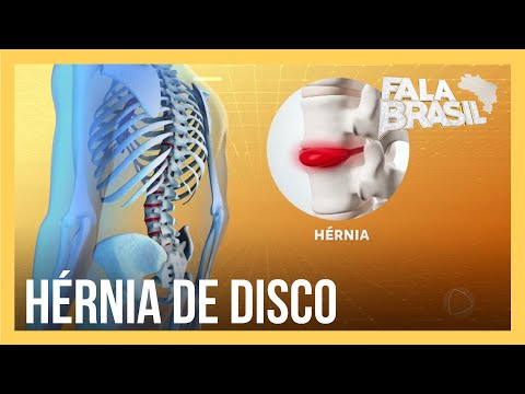 Saiba como tratar hérnia de disco, problema que causa dores na coluna