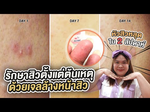Must Have Item : รักษาสิวตั้งแต่ต้นเหตุ ด้วยเจลล้างหน้า หัวสิวหลุดใน 2 สัปดาห์