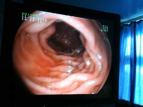 Camera Inside Throat 11