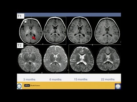 Neuroimaging of Pediatric Disease
