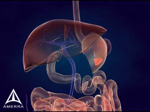 Whipple Procedure - 3D Medical Animation - YouTube pancreas cancer diagrams 