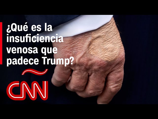 Diagnostican a Trump con insuficiencia venosa crónica. ¿Qué es esta condición de salud?