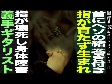 首にヘソの緒巻き付き 指が育たず生まれ…/指が壊死し身体障害/義手ギタリストLisa13