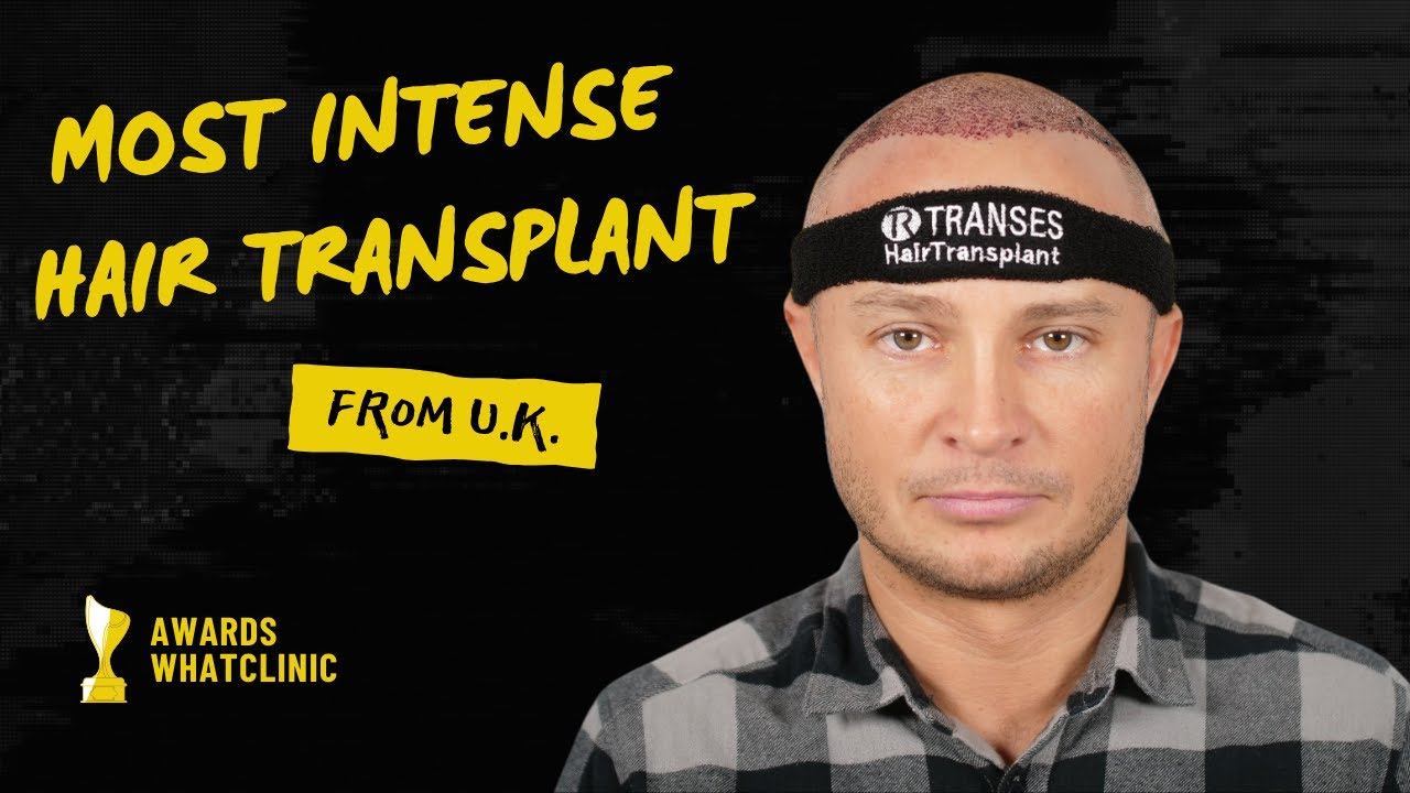 Transes Hair Transplant in the Turkey 
Get Permanent Hair in 6 Months with the Bio Ultrasonic Sapphire Fue or Dhi Method Let's Do Your Free Hair Analysis 
📲 : https://api.whatsapp.com/send?phone=905464494247&text=Hi, 
📞Whatsapp : 00905464494247 

DID YOU KNOW ITS FREE? 
100% Free Video Consultation
✅ So the patient knows how many grafts you needed 
✅Sapphire Fue or DHI Method Hair Transplant 
✅Professional Service with 14 Years of Experience 
✅More than 30,000 Successful Operations 
📍 Istanbul

#hairtransplant #hairtransplantresults #hairtransplantturkey #hairtransplanttimelapse #hairtransplantvideo #hairtransplantbeforeandafter #hairtransplantsurgery #hairtransplantprocedure #hairtransplantjourney #hairtransplantresultsmonthbymonth #hairtransplanttimeline #hairtransplantprocess #hairtransplantmalayalam #hairtransplantbangladesh #hairtransplantcost #hairtransplantand #hairtransplantandsmp #hairtransplantandresult #hairtransplantandprptreatmentresults #hairtransplantandminoxidil #hairtransplantandfinasteride #hairtransplantandscalpmicropigmentation #hairtransplantandmicropigmentation #hairtransplantandtrt #hairtransplantandcost #hairtransplantandgym #hairtransplantandexercise #hairtransplantandrogeneticalopecia #hairtransplantandprp #hairtransplantanderectiledysfunction