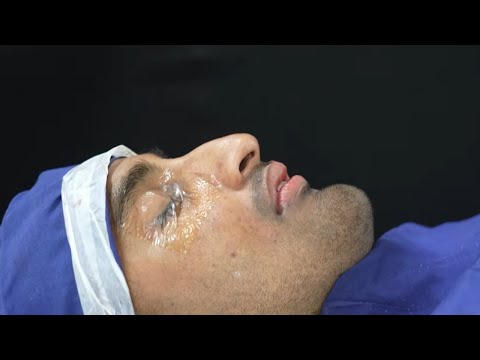 Before & After Jaw Surgery – 7 Day Recovery of Punjab Patient