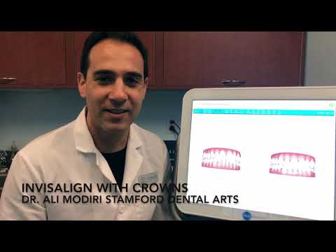 Invisalign with Crowns