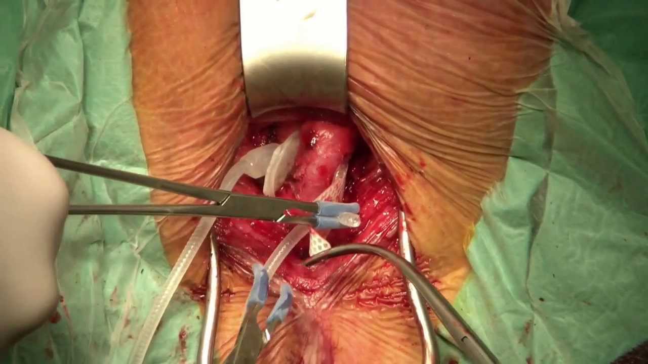 urinary sphincter implant