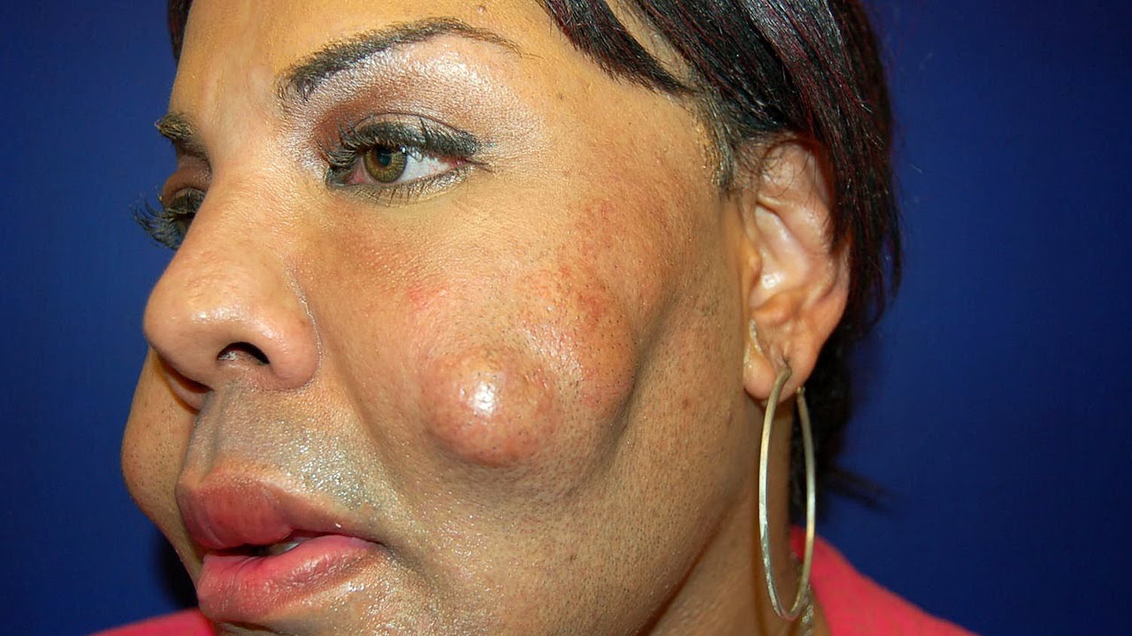 Cosmetic Surgery Disaster Woman Dubbed Cement Face Given New Lease Of Life YouTube