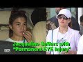 Jacqueline Fernandez Suffers with “Permanent EYE Injury”