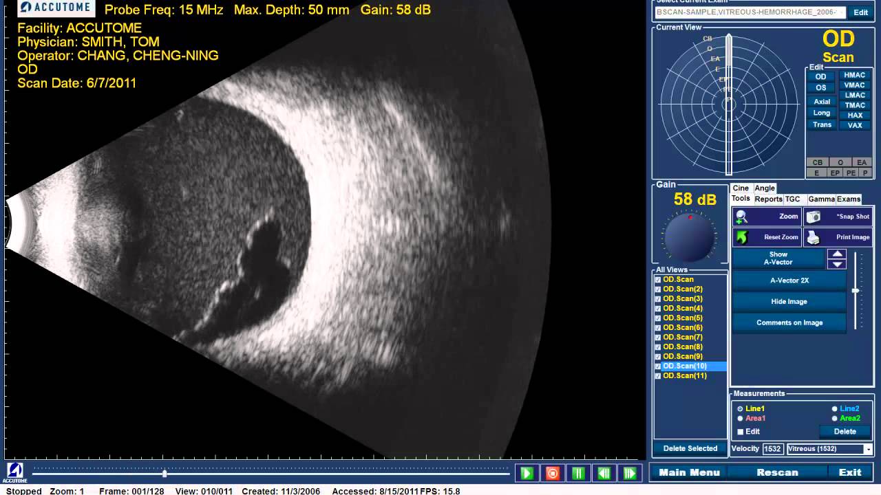 Accutome B-scan Plus - Vitreous Hemorrhage - YouTube